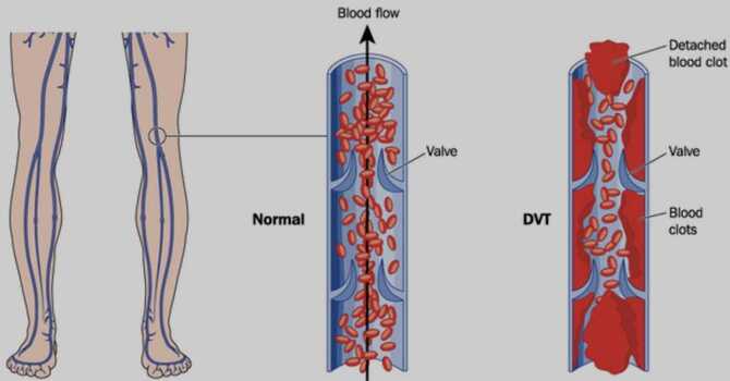 Navigating Hormone Replacement Therapy (HRT) for Women with Factor V Leiden: image