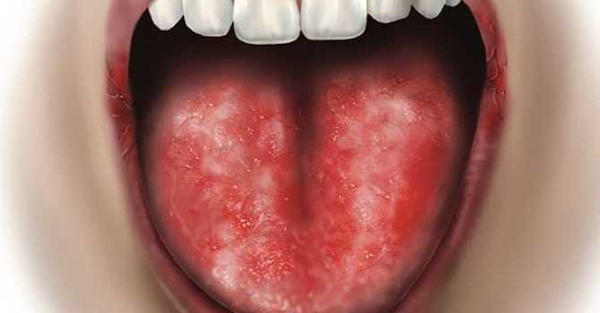 Burning Mouth Syndrome (BMS) image