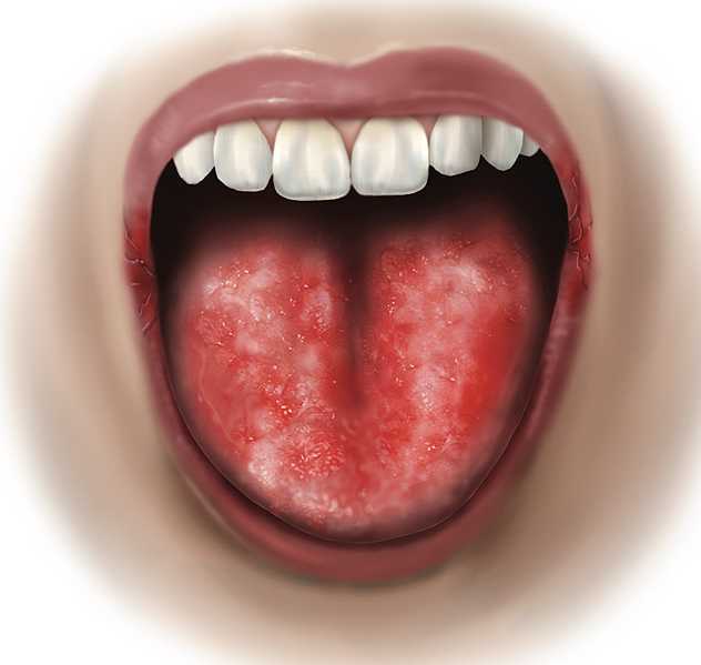 Burning Mouth Syndrome, Menopause Hormone therapy, MCAS, Hormone Replacement