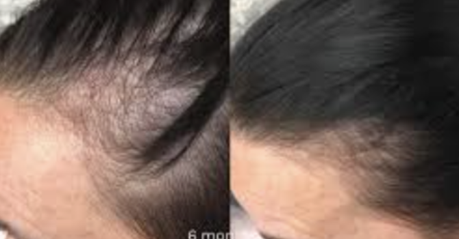 Hair Loss During Menopause: Causes, Treatments, and How to Regrow Thinning Hair