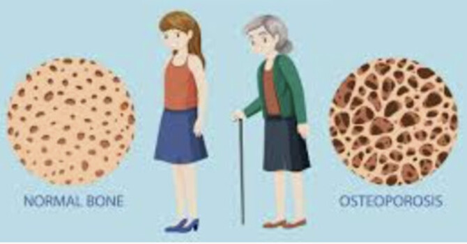 Your Bones Are Losing Ground Every Year After 40: What HRT Actually Does About It